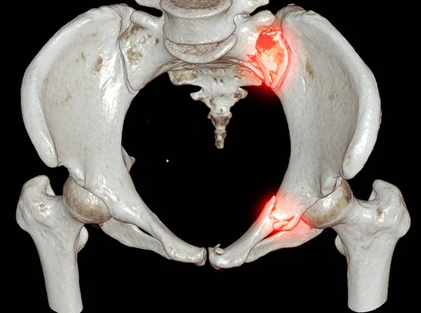 髋关节三维显示骶骨骨折和上耻骨隆起的Ct扫描骨盆 — 图库照片