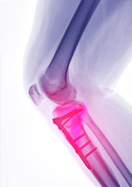 Sağ dizin x-ray görüntüsü. Yan görünüm, diz eklemi ve kaval kemiği kırıkları gösteriyor. Plakası ve vida sabitlemesi..