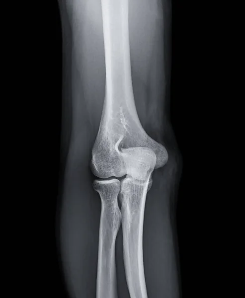 Radiografía Articulación Del Codo Vista Frontal — Foto de Stock