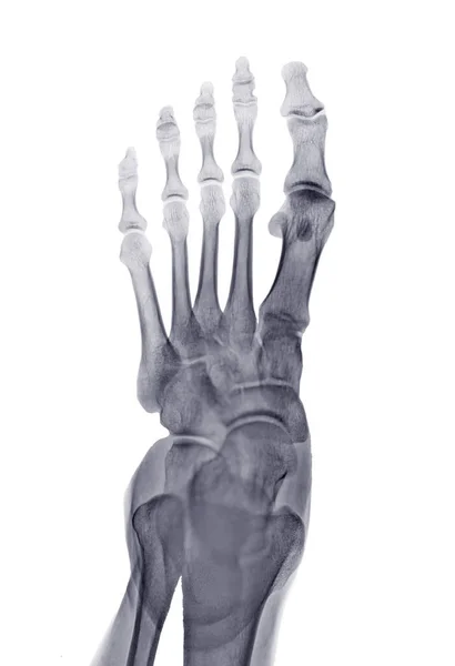 白色背景下孤立的足部X射线图像Ap Iew — 图库照片