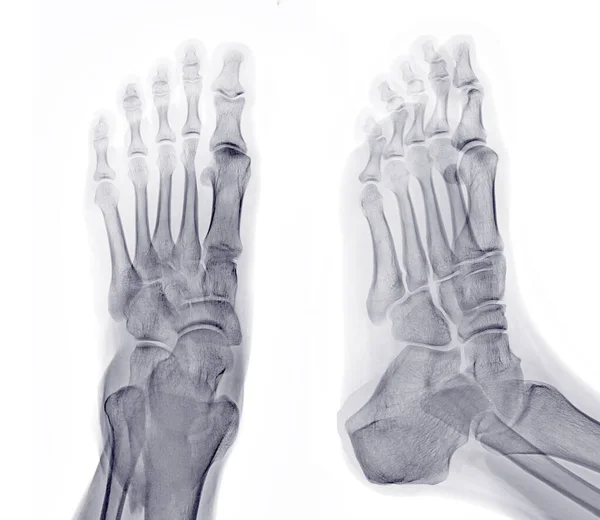Fuß Röntgenbild Und Schrägansicht Isoliert Auf Weißem Hintergrund — Stockfoto