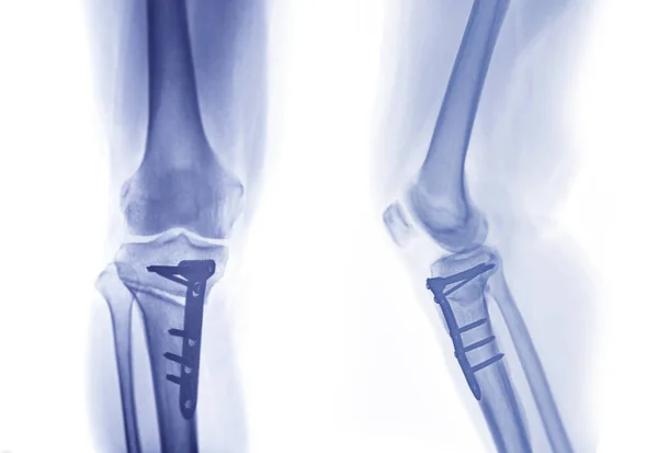 Ray Image Right Knee Lateral View Showing Total Knee Arthroplasty — ストック写真