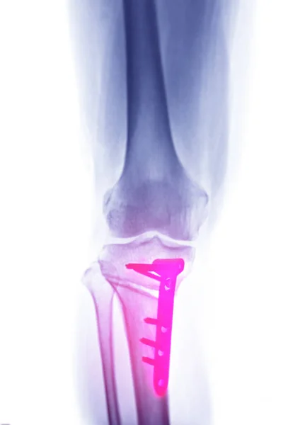 右膝关节Ap显示全膝关节置换术及胫骨平台骨折的X线图像及钢板螺钉固定 — 图库照片