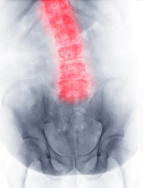 腰椎脊柱或L S脊柱前视显示脊柱侧弯的X线图像 — 图库照片