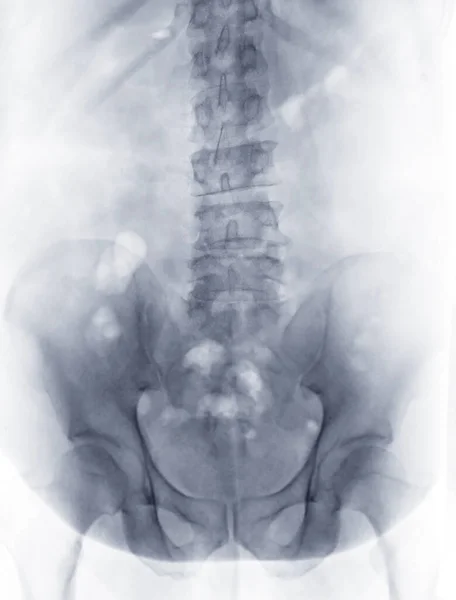 Röntgenbild Der Lendenwirbelsäule Oder Wirbelsäule Seitenansicht Zur Diagnose Von Rückenschmerzen — Stockfoto