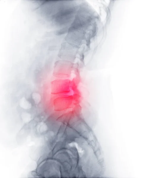 Ray Image Lumbar Spine Spine Post Operative Fix Lumbar Plates — Stock Photo, Image