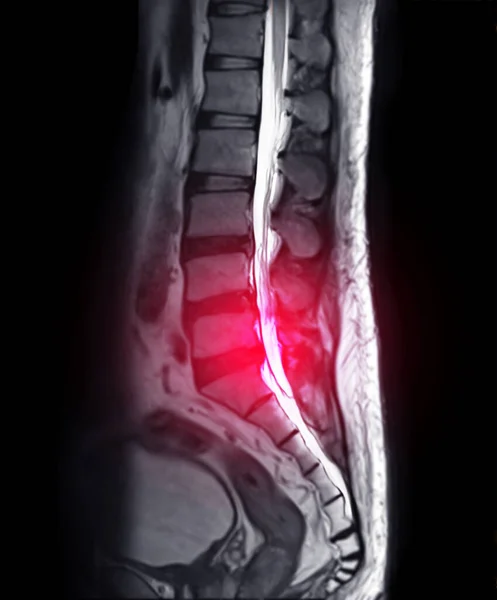 Mri S脊柱或Lambar脊柱矢状T2技术诊断脊髓压迫 — 图库照片