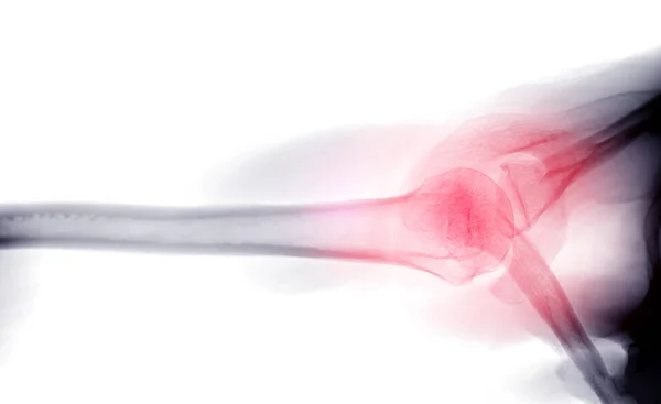 Radiografía Articulación Del Hombro Vista Transaxilar Del Hombro Para Diagnóstico — Foto de Stock