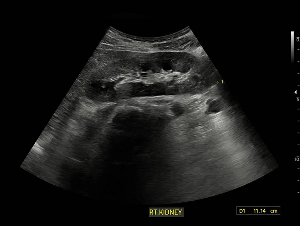 Ultrasound Kidney Kub Screening Renal Stone Disease Urolithiasis — Stock Photo, Image