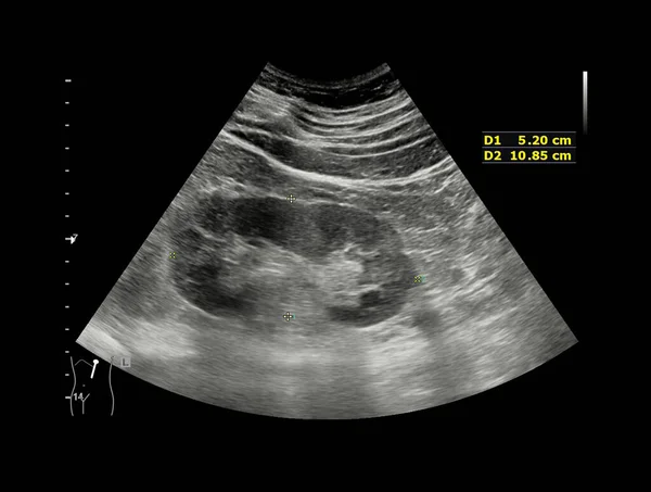 Ultrasound Kidney Kub Screening Renal Stone Disease Urolithiasis — Stock Photo, Image