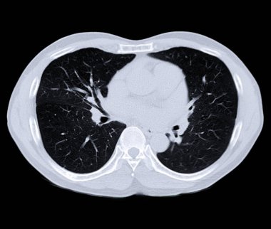 CT scan of Chest or lung for screening lung nodules and lung cancer . clipart