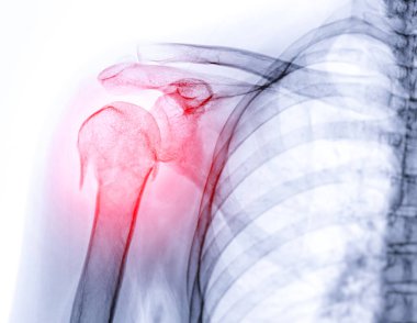 X-ray of Shoulder joint  showing fracture of humerus bone. clipart