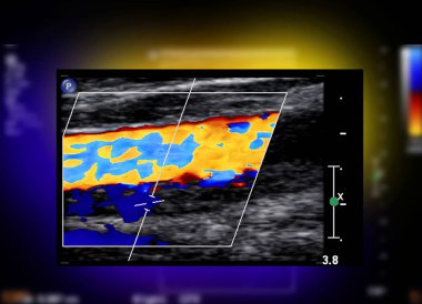 A carotid artery Doppler ultrasound is a diagnostic test the arteries in the neck for diagnosis  any blockage in the veins by a blood clot or thrombus formation. clipart