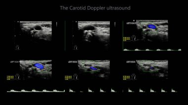 Karotid arter Doppler ultrasonu, kan pıhtısı ya da trombüs oluşumu ile damarlardaki tıkanıklığı teşhis etmek için boyundaki atardamarların test edilmesidir..