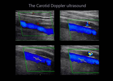 Karotid arter Doppler ultrasonu, kan pıhtısı ya da trombüs oluşumu ile damarlardaki tıkanıklığı teşhis etmek için boyundaki atardamarların test edilmesidir..