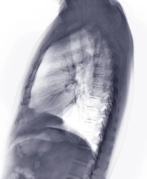 Brust Röntgen Oder Röntgenbild Der Menschlichen Lungen Seitenansicht Mit Voller — Stockfoto