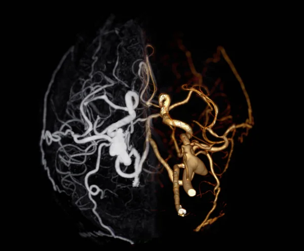 Angiographie Des Gehirns Oder Cta Gehirns Mit Cerebralarterie — Stockfoto
