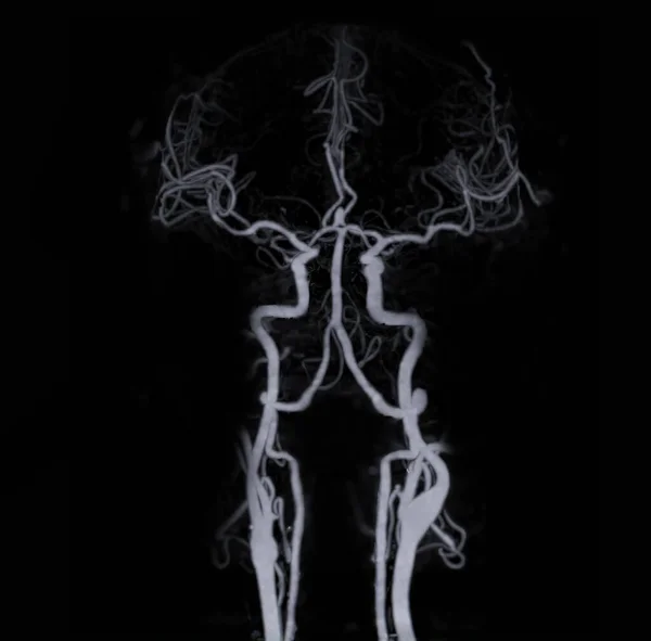 Angiografia Del Cervello Del Cervello Cta Che Mostra Arteria Cerebrale — Foto Stock