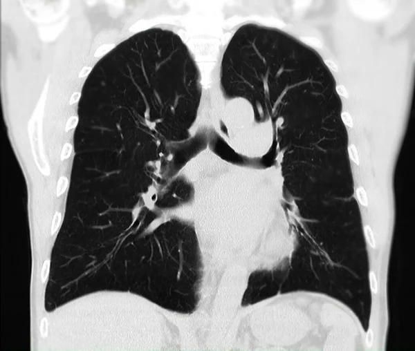 Der Brust Oder Lunge Zur Früherkennung Von Lungenknoten Und Lungenkrebs — Stockfoto