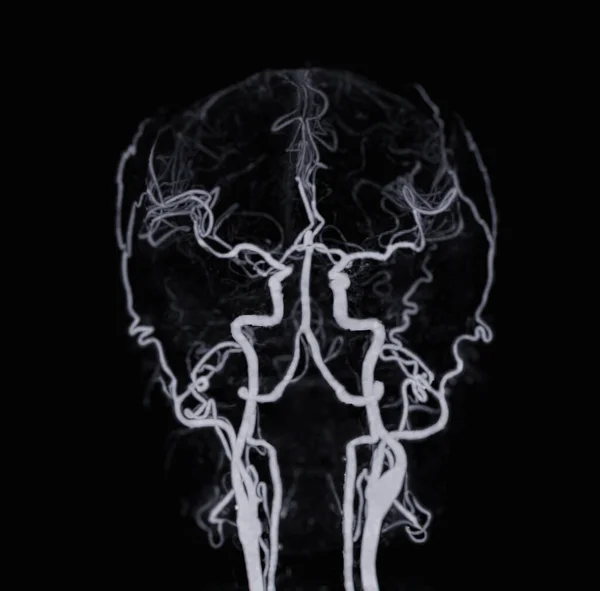 脑或Cta脑显示脑动脉的Ct血管造影 — 图库照片