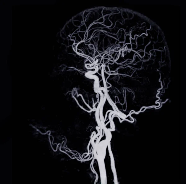 Ангиография Головного Мозга Cta Показывающая Мозговую Артерию — стоковое фото