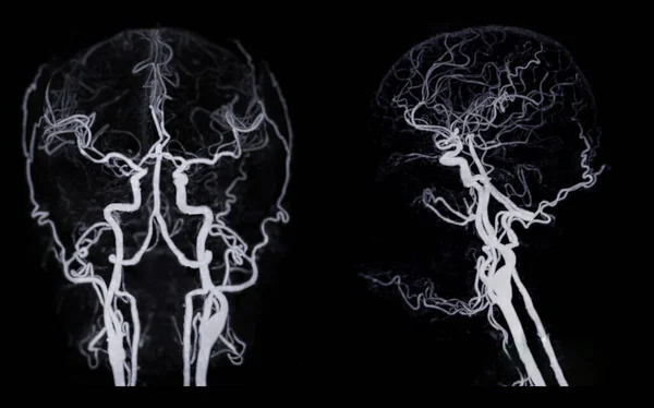 Beyin Tomografisi Beyin Tomografisi Beyin Arterini Gösteriyor — Stok fotoğraf