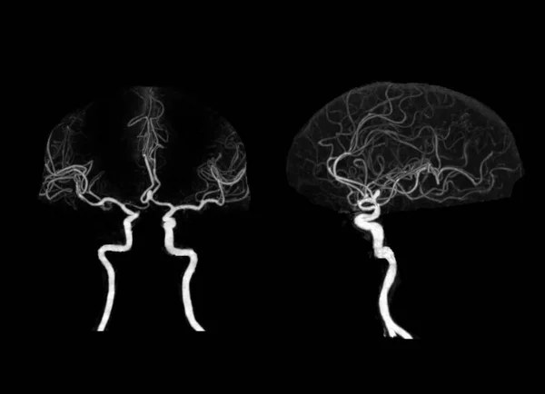Angiografie Van Hersenen Cta Hersenen Met Cerebrale Slagader — Stockfoto