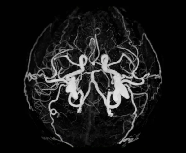 Angiographie Des Gehirns Oder Cta Gehirns Mit Cerebralarterie — Stockfoto