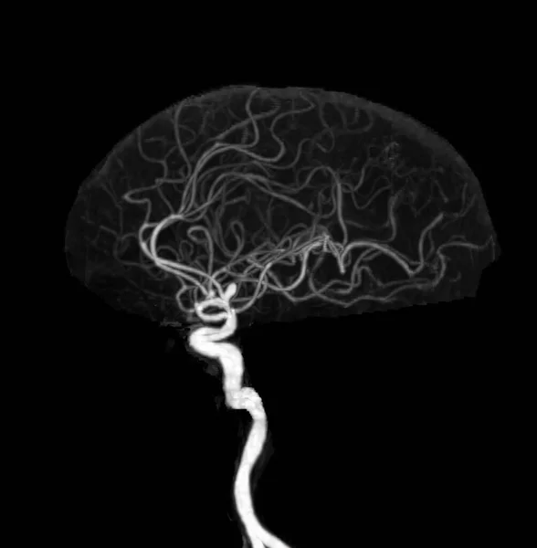 Angiografía Por Del Cerebro Atc Que Muestra Arteria Cerebral — Foto de Stock