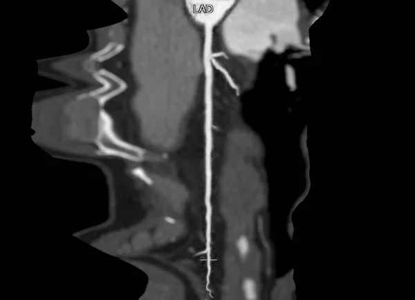 Cta Arteria Coronaria Refomación Curva Que Muestra Arteria Coronaria Izquierda —  Fotos de Stock
