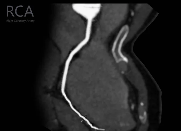 Cta Arteria Coronaria Refomación Curva Que Muestra Arteria Coronaria Derecha —  Fotos de Stock