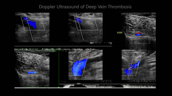 Barva Dopplerova Ultrazvukové Stanovení Pacientů Hlubokou Žilní Trombózou Pro Nalezení — Stock fotografie