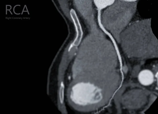 Cta Arteria Coronaria Refomación Curva Que Muestra Arteria Coronaria Derecha —  Fotos de Stock