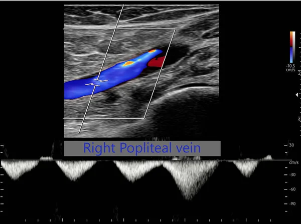 Determinación Por Ultrasonido Doppler Color Pacientes Con Trombosis Venosa Profunda —  Fotos de Stock