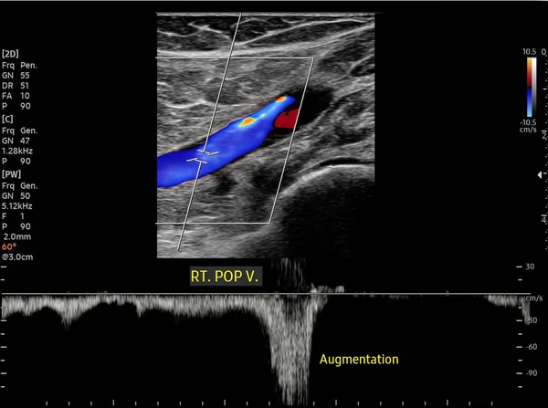 Barva Dopplerova Ultrazvukové Stanovení Pacientů Hlubokou Žilní Trombózou Pro Nalezení — Stock fotografie