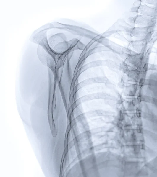 Ray Shoulder Joint Transcapula View Showing Normal Scapula Bone — Stock Photo, Image