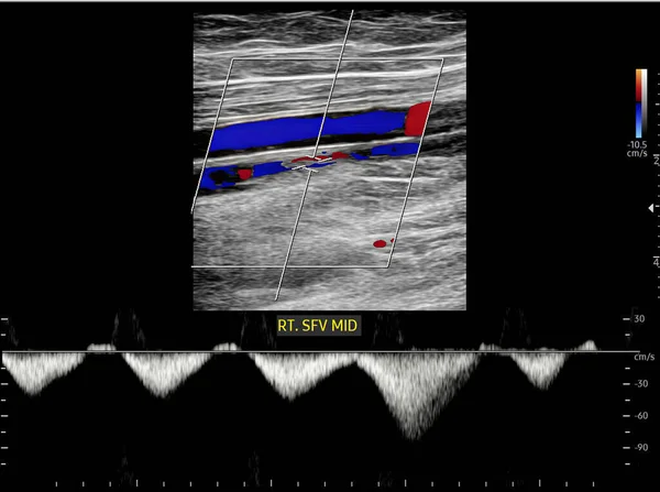 Determinación Por Ultrasonido Doppler Color Pacientes Con Trombosis Venosa Profunda —  Fotos de Stock