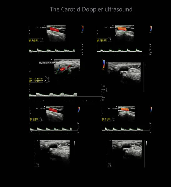 Karotidní Tepna Doppler Ultrazvuk Diagnostický Test Tepny Krku Pro Diagnózu — Stock fotografie