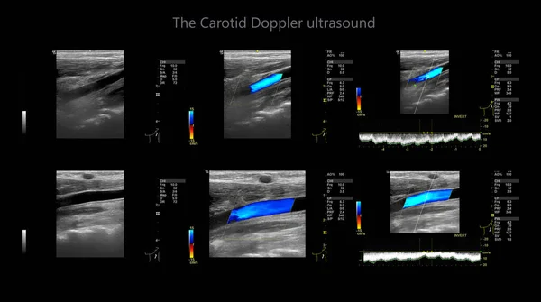 Karotidní Tepna Doppler Ultrazvuk Diagnostický Test Tepny Krku Pro Diagnózu — Stock fotografie