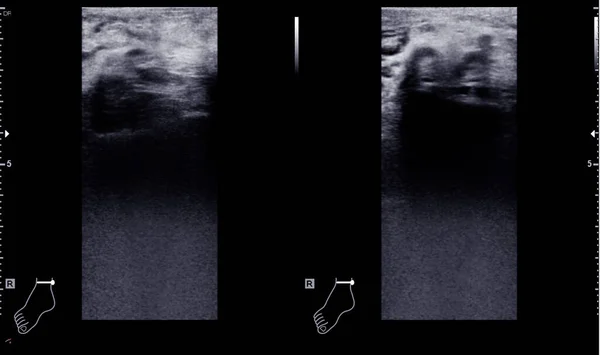 stock image Color Doppler ultrasound determination in deep vein thrombosis patients for finding  deep vein thrombosis of lower extremity.