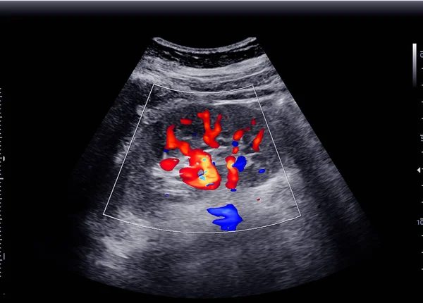 Ultrasound Kidney Kub Screening Renal Stone Disease — Stock Photo, Image