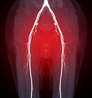 Kronik Akut veya Kronik Periferik Arter Hastalığı teşhisi için femoral arterin görüntüsü alınamıyor..