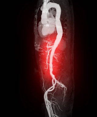 CTA whole aorta 3D rendering.