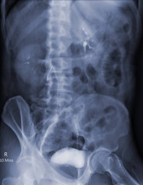  İntravenöz piyelogram ya da I.V.P, enjekte edildikten sonra idrar yollarının X-ray muayenesidir.  .