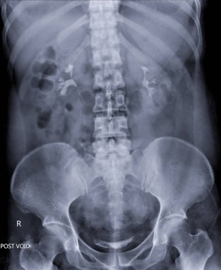  İntravenöz piyelogram ya da I.V.P, enjekte edildikten sonra idrar yollarının X-ray muayenesidir.  .