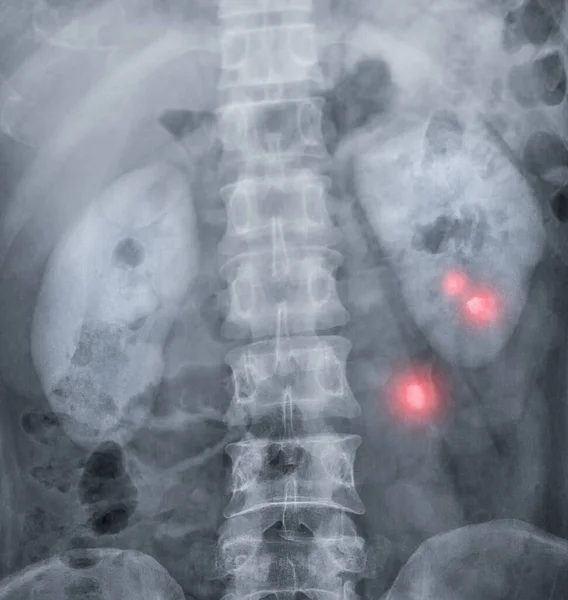 Pyélogramme Intraveineux Est Examen Radiographique Des Voies Urinaires Après Injection — Photo