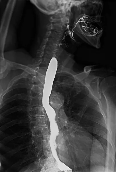 Barium Swallow Study Test Diagnose Barrett Tract Exam Gerd Ulcers — Stock Photo, Image
