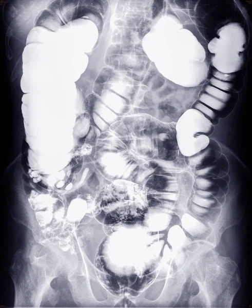Barium Einlauf Untersuchungsbild Oder Röntgenbild Des Dickdarms — Stockfoto