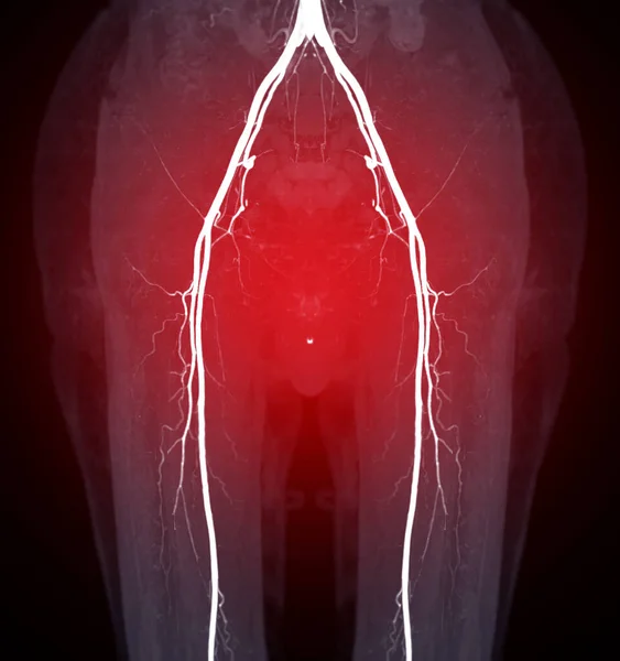 Cta大腿骨動脈は 診断のための大腿骨動脈の画像を実行します急性または慢性末梢動脈疾患 — ストック写真