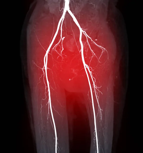 CTA femoral artery run off image of femoral artery for diagnostic  Acute or Chronic Peripheral Arterial Disease.